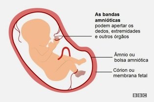 Imagem ilustrativa do artigo Bridas amnióticas: o que são, causas e tratamento