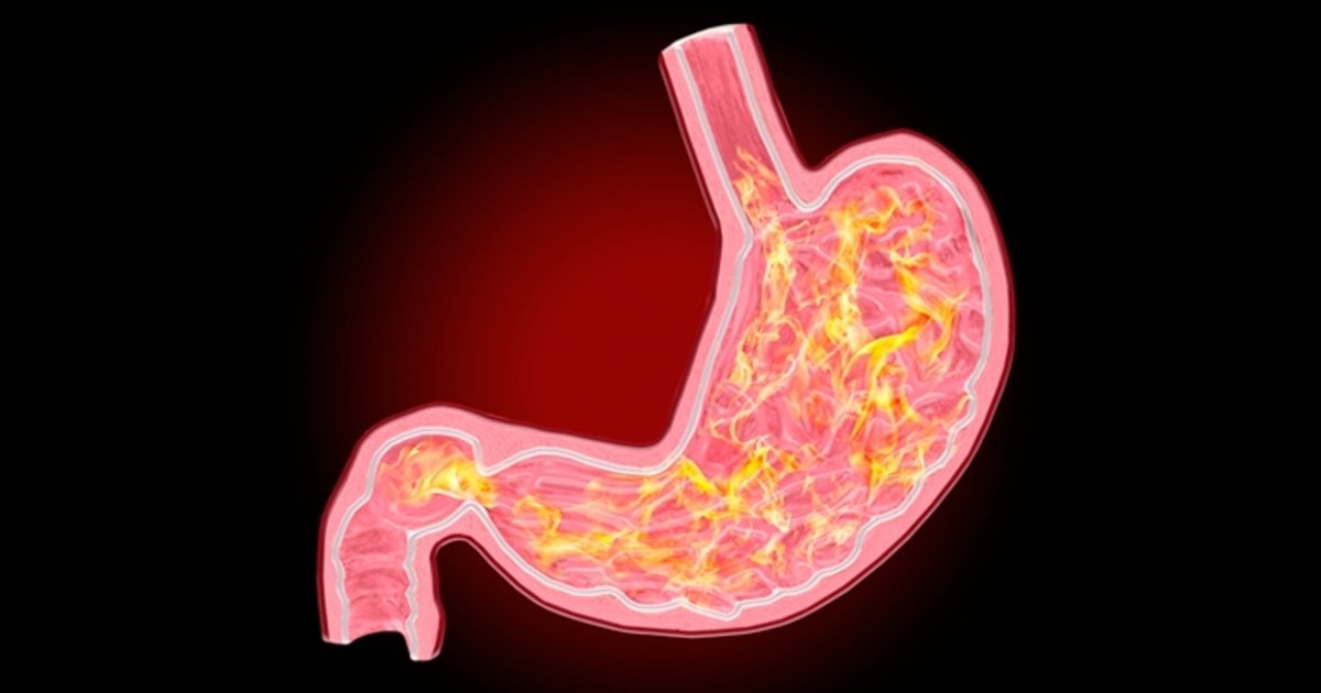 Gastritis Sintomas Y Como Tratar Tua Saude