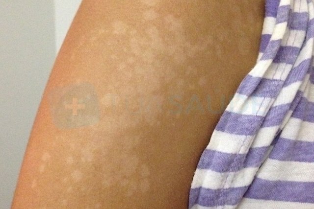 Tratamiento para los hongos en la piel con antimicÃ³ticos