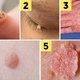 Warts: Types, Causes & How to Get Rid of Them