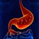 Stomach Ulcer: Symptoms, Diagnosis, Causes & Treatment