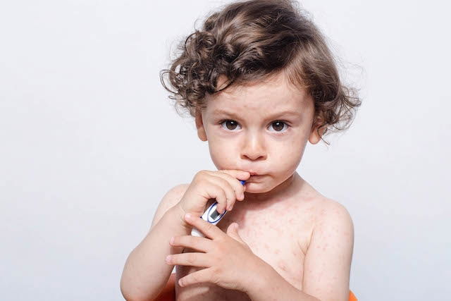 Illustrative image of the article Roseola: What Is It, Symptoms & Treatment Options