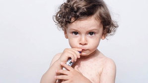 Infant Roseola What Is It Symptoms And Treatment Options Tua Saude