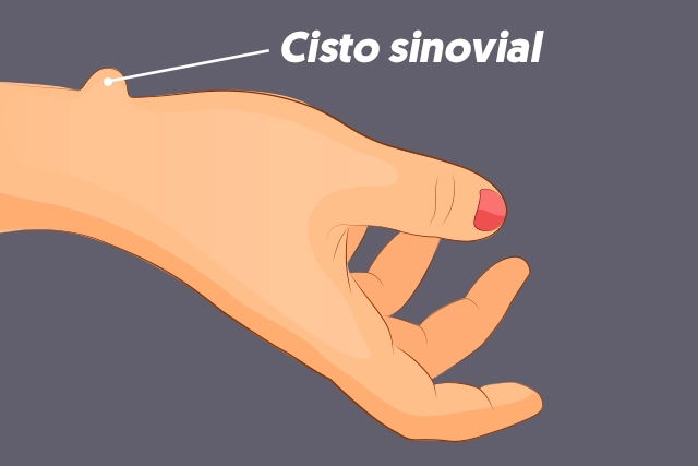 Cisto sinovial: o que é, sintomas, causas e tratamento - Tua Saúde