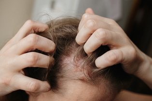 Imagen ilustrativa del artículo 9 enfermedades del cuero cabelludo (y qué hacer)