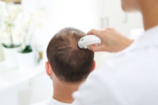 Imagem ilustrativa do artigo Alopecia cicatricial: o que é, sintomas, causas, tipos e tratamento