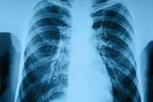 Imagem ilustrativa do artigo Pneumonia hospitalar: o que é, sintomas causas e tratamento