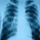 Pneumonia hospitalar: o que é, sintomas causas e tratamento