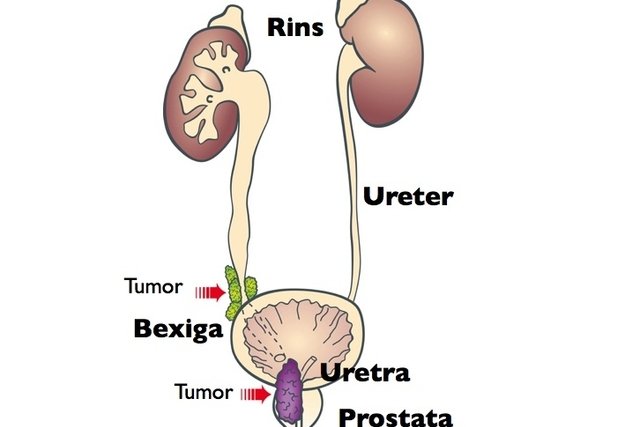 cancer de prostata afeta os rins)