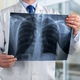 8 principais sintomas de tuberculose