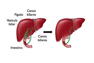 Fígado com e sem vesícula