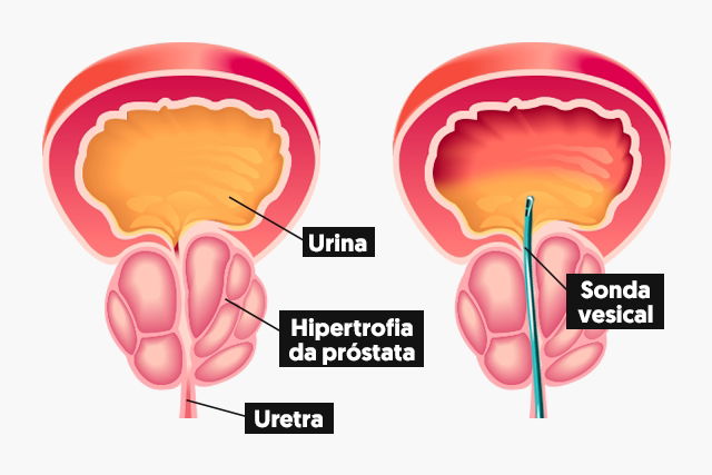 Sonda vesical de demora ou de alívio para que servem e diferenças