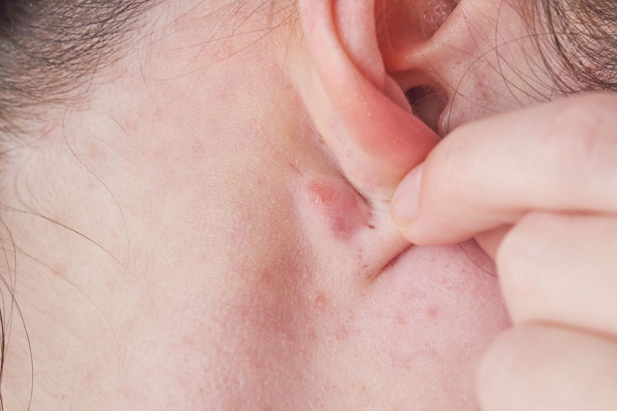 Lumps Behind The Ear 6 Causes When To See A Doctor Tua Sa de