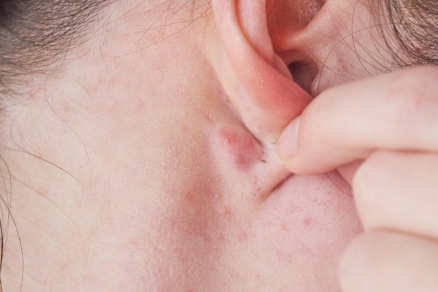 cancerous tumor behind ear