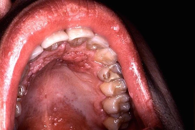 virus de papiloma boca)