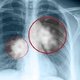 Mancha no pulmão: 4 possíveis causas e o que fazer
