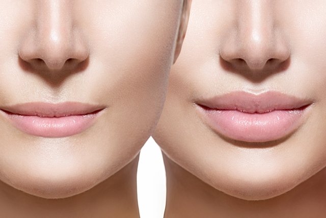 يمكن أن تؤدي الجراحة التجميلية في الفم إلى تكبير الشفاه أو تصغيرها.