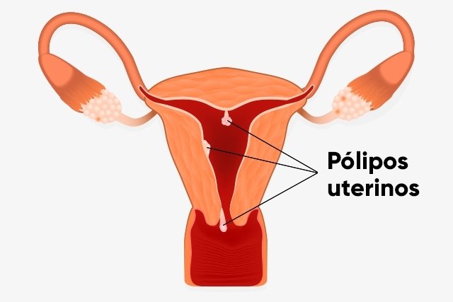 8 Síntomas de pólipos endometriales y ¿son peligrosos? - Tua Saúde
