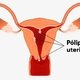 8 Síntomas de pólipos endometriales y ¿son peligrosos?