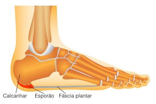 Como identificar o esporão no pé, causas e o que fazer