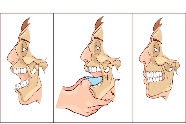 Mandíbula travada: confira o que é como destravar o maxilar!