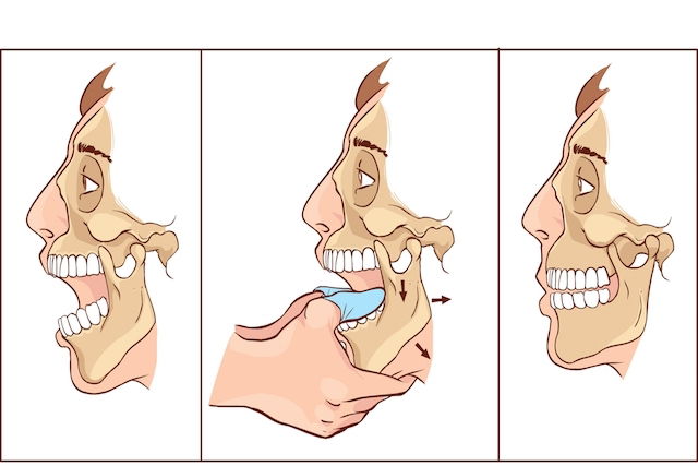 Qual médico trata o maxilar ou mandíbula estalando? - Tua Saúde