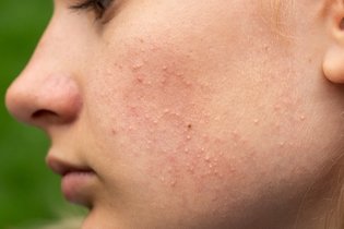 Imagem ilustrativa do artigo 8 principais tipos de acne (e o que fazer)