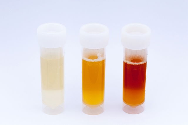 Mucus in Urine: What's Causing It?