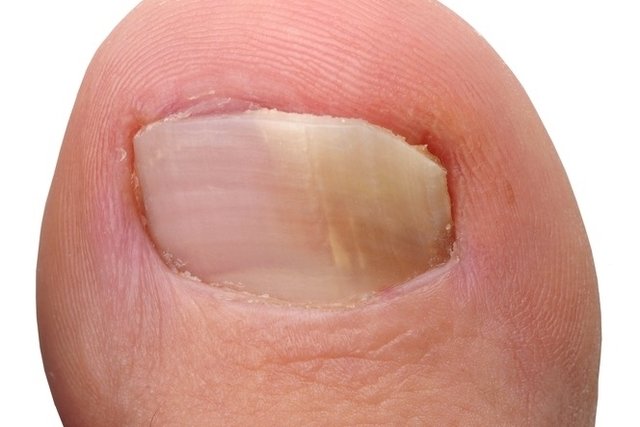 Borax în tratamentul unghiilor ciuperca, Crema de ciuperci de unghii deget de la picior
