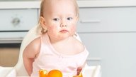 Alergia alimentar no bebê: sintomas, causas e o que fazer