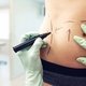 8 dúvidas sobre a recuperação da abdominoplastia