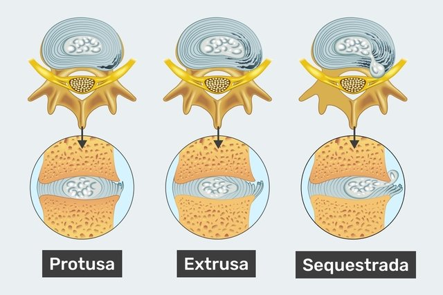 ilustração mostrando os diferentes tipos de hérnia de disco