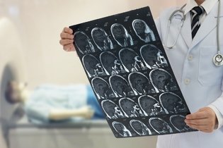 Edema cerebral: o que é, sintomas, causas e tratamento