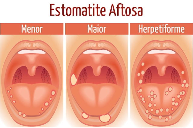 Como identificar e tratar a Estomatite Aftosa Tua Saúde