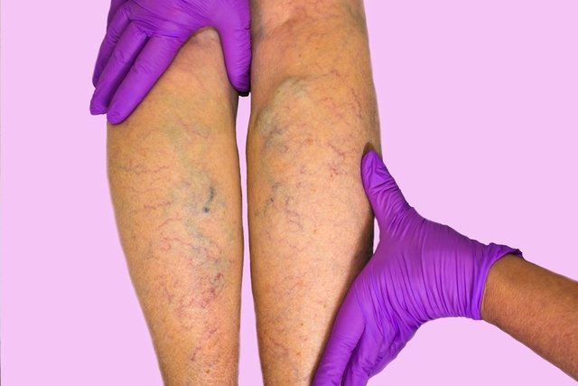 Manchas en las piernas: 7 causas y qué