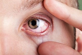 Imagem ilustrativa do artigo Como combater o Olho Seco