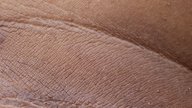  Manchas en la piel: tipos y causas comunes