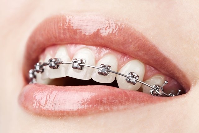 death satire Rewarding Aparelho dentário: tipos, quando é indicado e cuidados - Tua Saúde