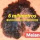 Sinais e sintomas de melanoma na pele (método ABCD)