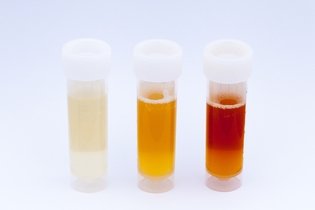 Blood in Urine: 5 Common Causes & What to Do
