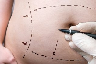 Imagen ilustrativa del artículo Abdominoplastia: qué es, cómo se realiza y vea el antes y después