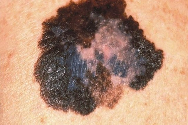 سرطان الجلد: ما هو وأهم أنواعه وعلاجه.