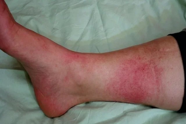 Red Spots On Skin: Top 19 Causes (with Pictures & Treatment) - Tua