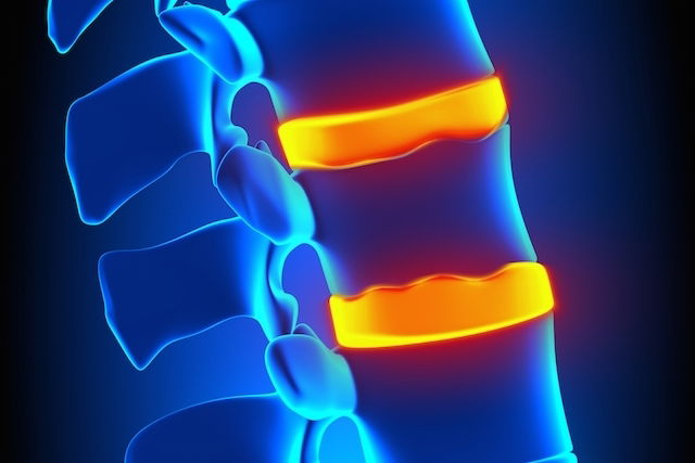 Hernia De Schmorl Causas Síntomas Y Tratamiento Tua Saúde