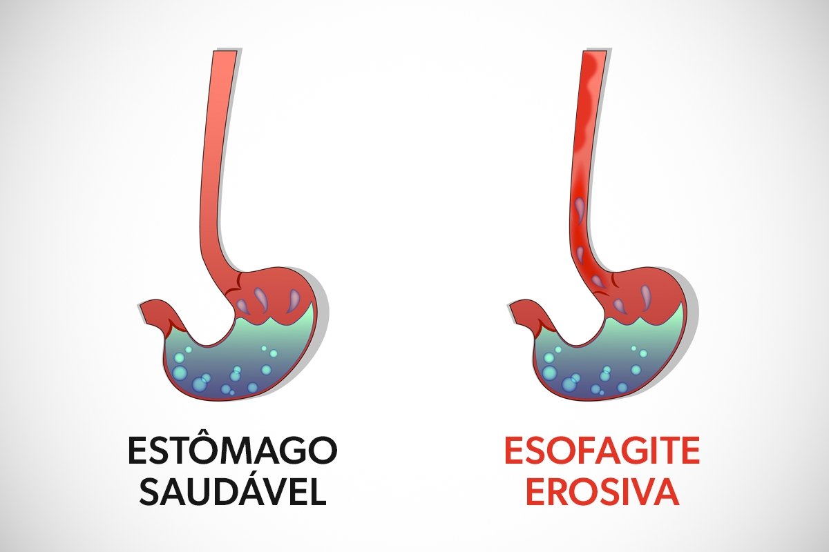esofagite erosiva o que é tratamento e classificação de los angeles