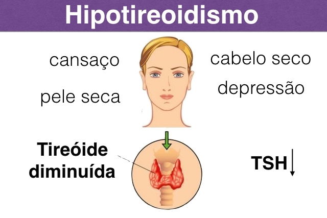 Hipotireoidismo Sintomas e Tratamento Tua Saúde