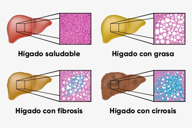 Como eliminar la grasa del hígado