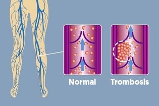 Imagen ilustrativa del artículo Trombosis: qué es, síntomas y tratamiento