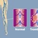 Trombosis: qué es, síntomas y tratamiento
