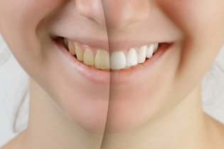 ¿Cómo blanquear los dientes?: 8 tratamientos efectivos